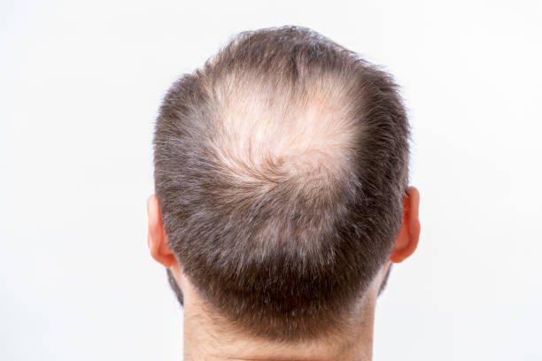 Thumbnail for Male pattern baldness